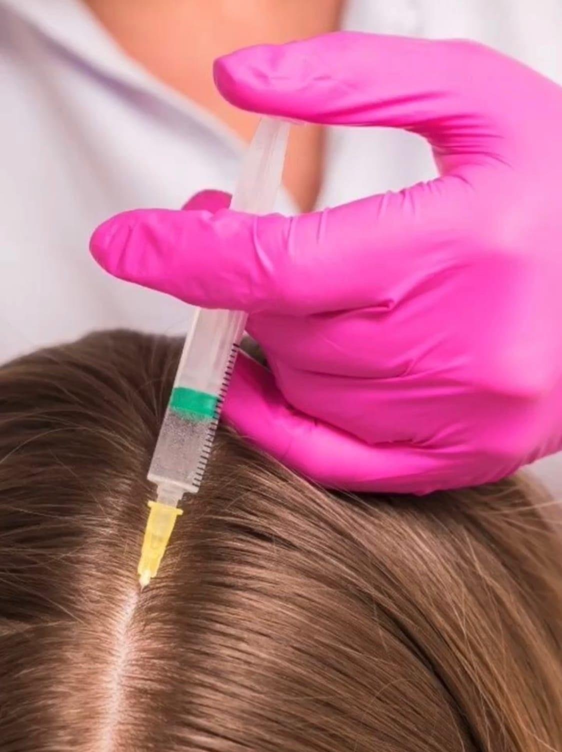 Мезотерапия для волос. Плазмолифтинг кожи головы. Плазмотерапия плазмолифтинг. Плазмотерапия для волос что это. Плазмотерапия для волос что это.